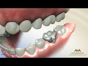 طقم شريط مولي أنبوبي 80 قطعة