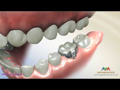 طقم شريط مولي أنبوبي 80 قطعة